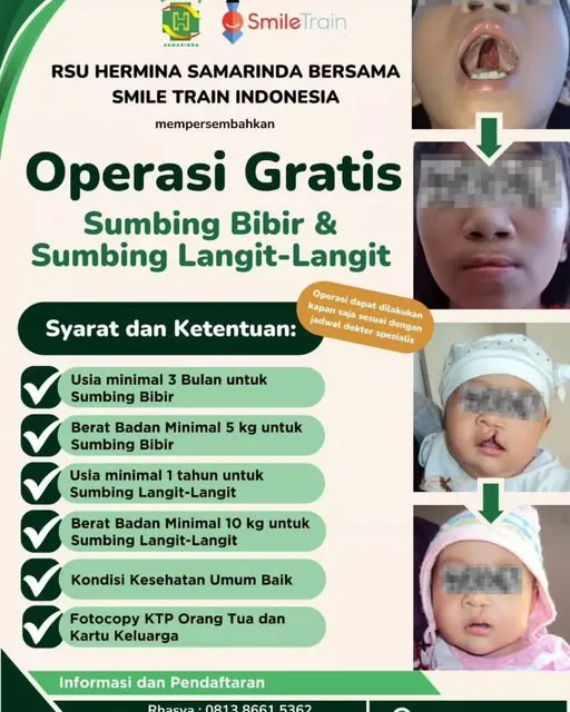 RS Hermina Samarinda bekerja sama dengan Smile Train Indonesia mengadakan program operasi sumbing bibir dan sumbing langit -langit  secara GRATIS.