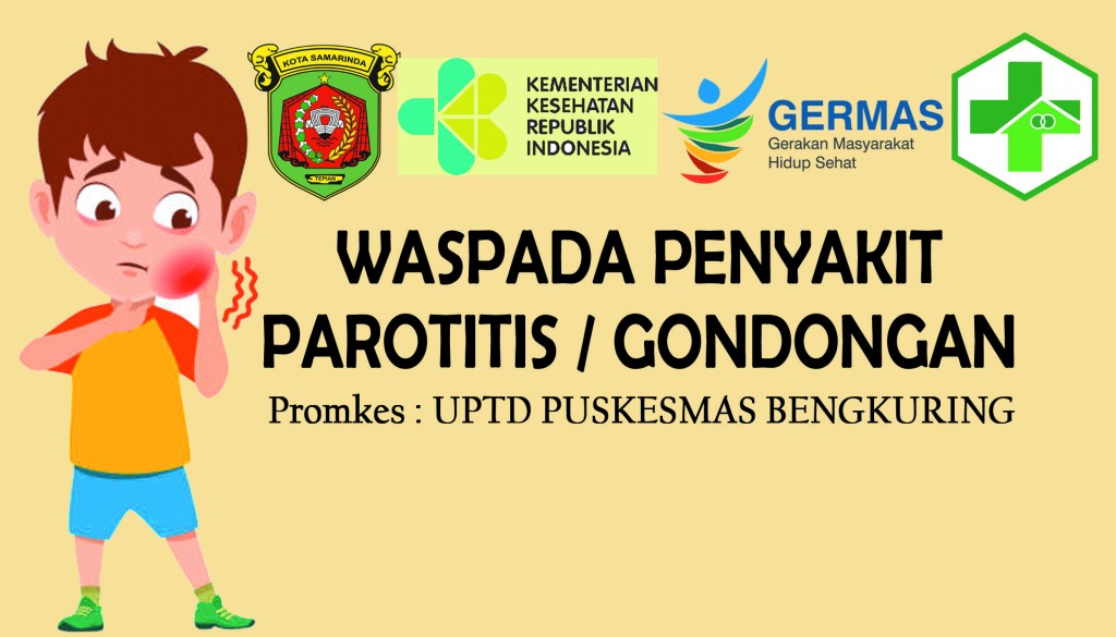 Waspada Parotitis/Gondongan..!